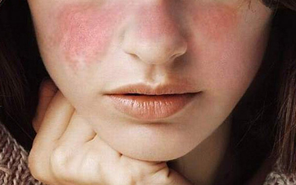 Viêm thận lupus là một dạng của viêm thận